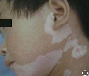 孩子白癜风，白癜风痊愈