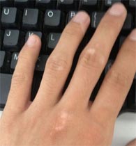 患白癜风要注意什么,患白癜风哪些事项要注意