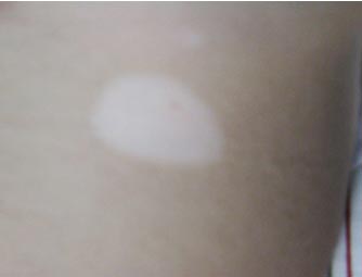 女性得白癜风的症状,女性患上白癜风的症状
